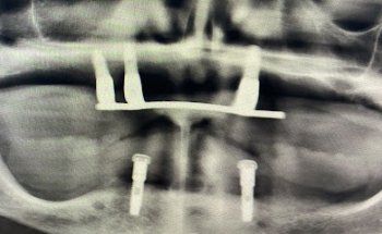 Fexdental