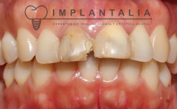Implantalia