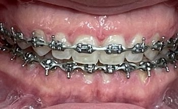 Dentalpalmar
