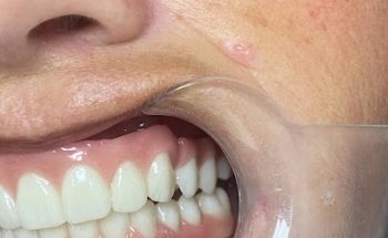 Dental Implants Mexico by Moguel & Frutos